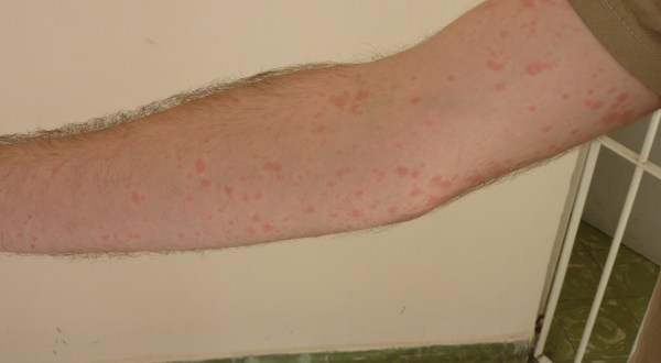 Beach-Goers In New Jersey Beware: Sea Lice Have Been Discovered At The Jersey Shore